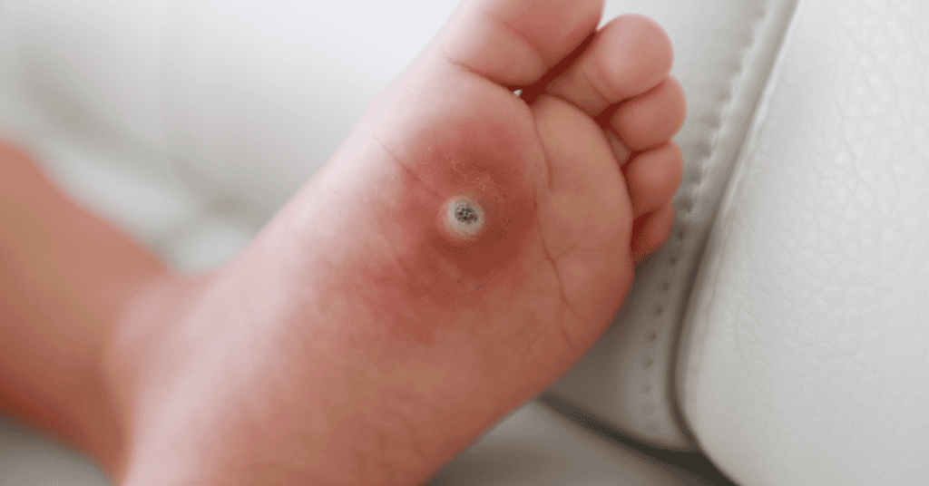 Verrugas plantares en niños la infección silenciosa que se contagia en piscinas y vestuarios
